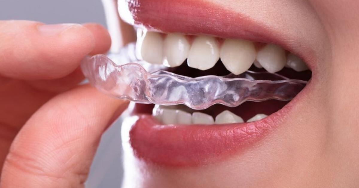 Invisalign-San Jose