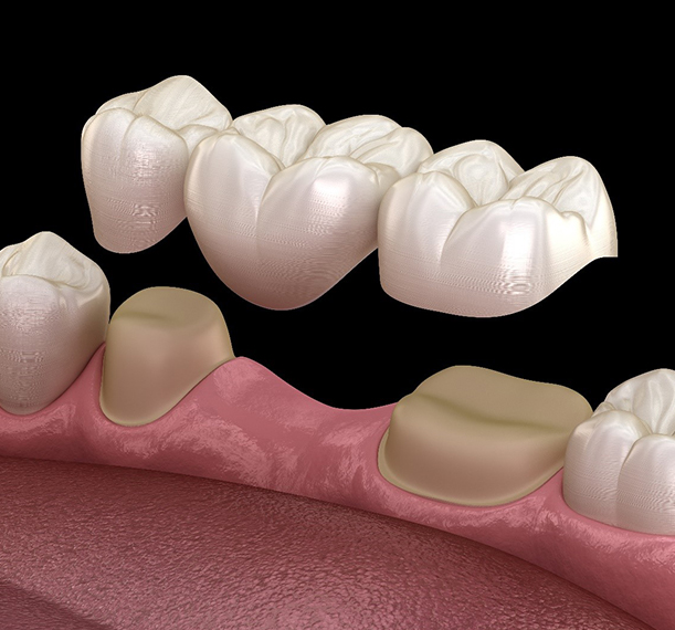 Dental Crowns in San Jose - Sparkling Smile Dental San Jose