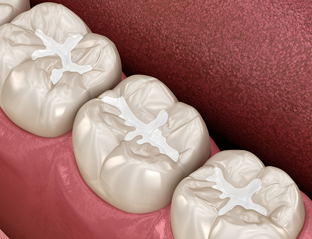 White fillings in San Jose - Sparkling Smile Dental San Jose